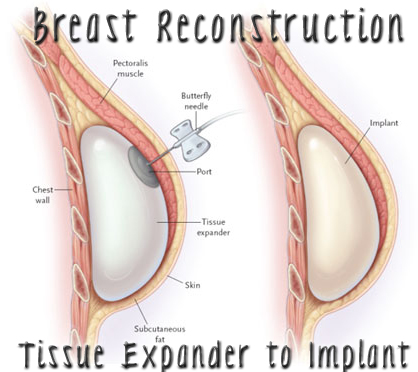 breast reconstruction