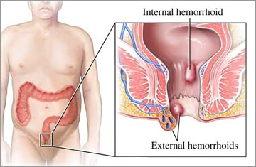 haemorrhoids in dubai