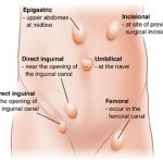 Hernia 03