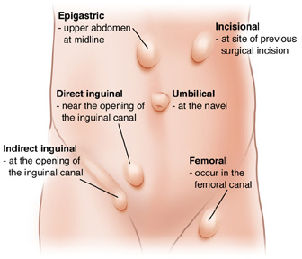hernia dubai