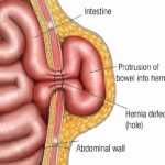 Hernia-defect
