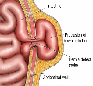 hernia specialist in dubai
