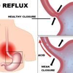 Acid Reflux