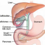 Gallstones