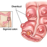 colon