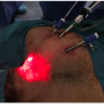 Laproscope