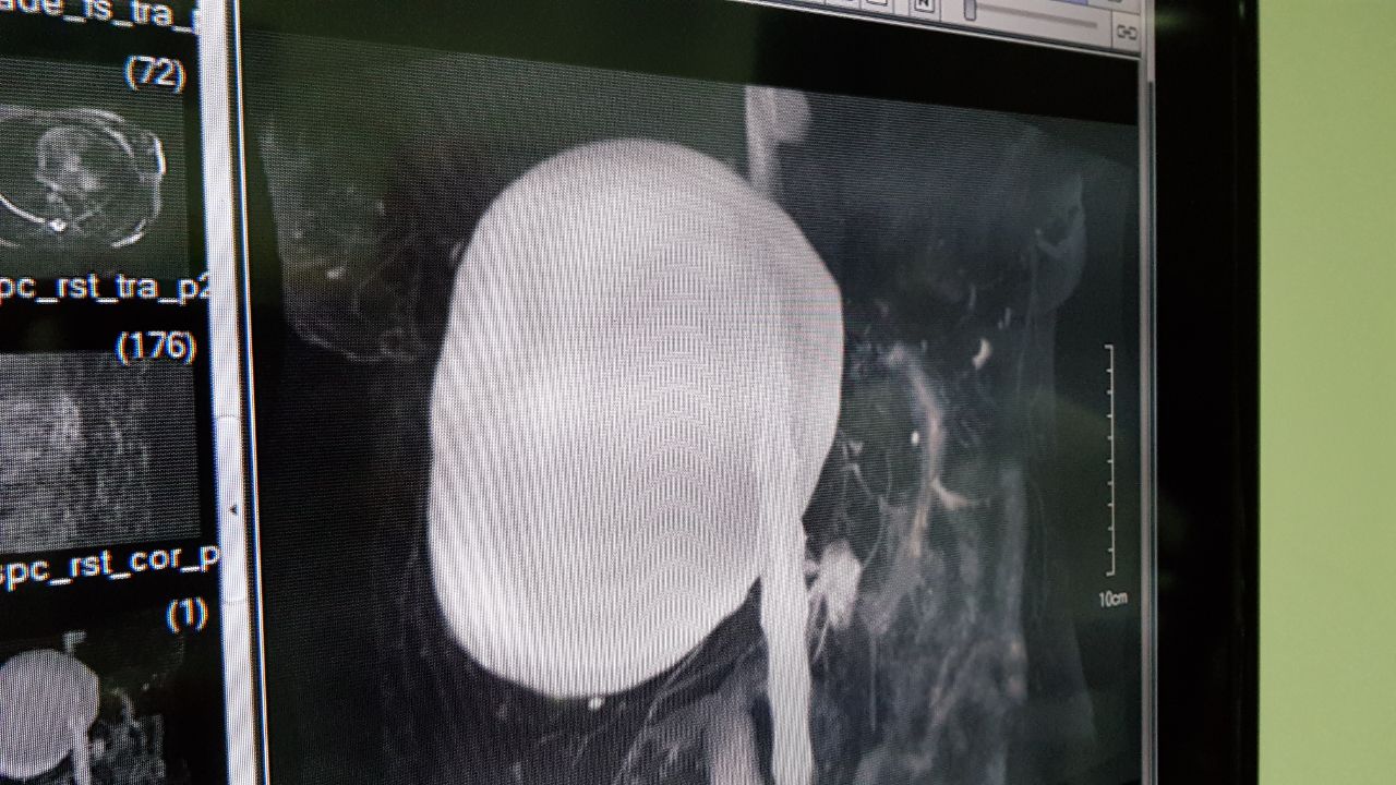 Cystic-Liver-01