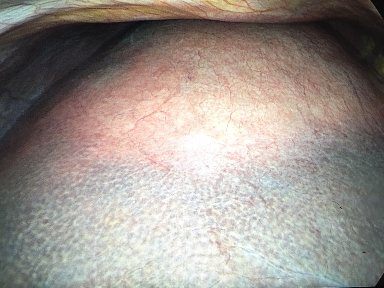 Cytsic-Liver-02