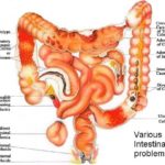 colon-diseased