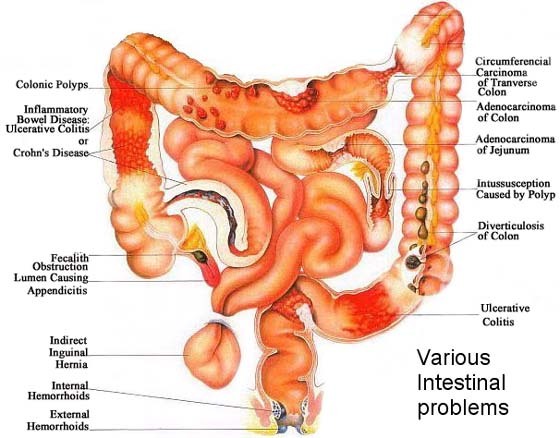 colon-diseased