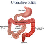 ulcerative-colitis