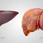 liver cirrhosis