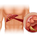 liver damage