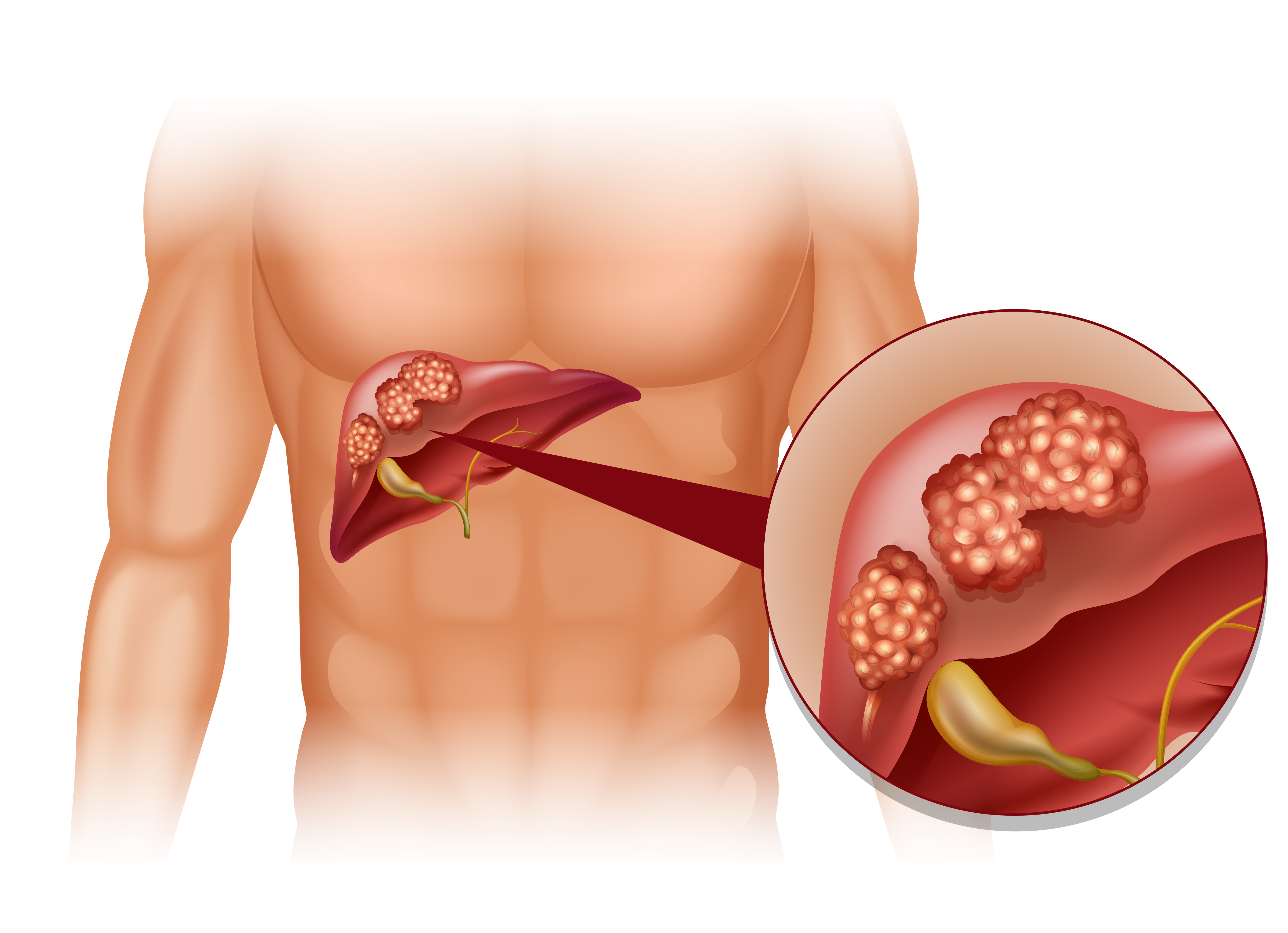liver damage