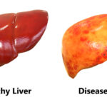 disease liver