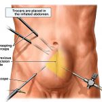 Laproscopic