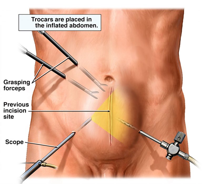 How to know if u have a hernia