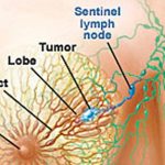 sentinel lymph node