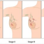 stages of breast cancer