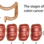 stages