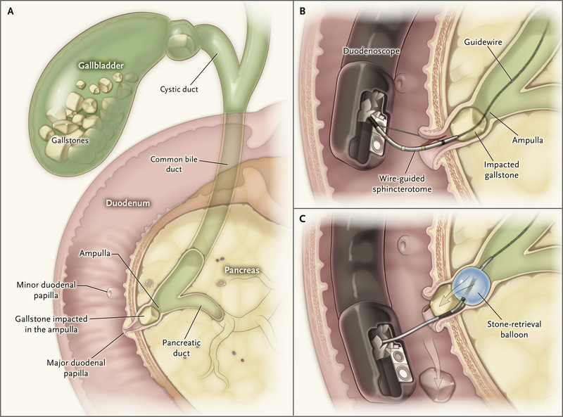 Gallstones causing pancreatitis